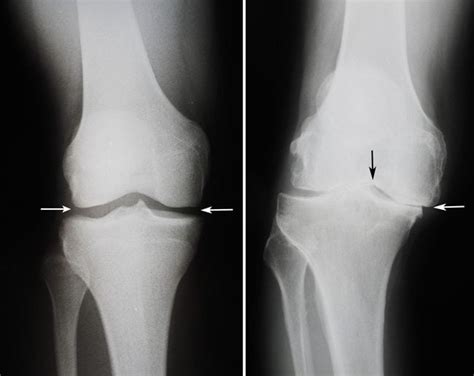 диагноза артроза на коляното